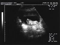 echo 's van uw ongeboren kind - de eerste baby foto 's - professionele echoscopie